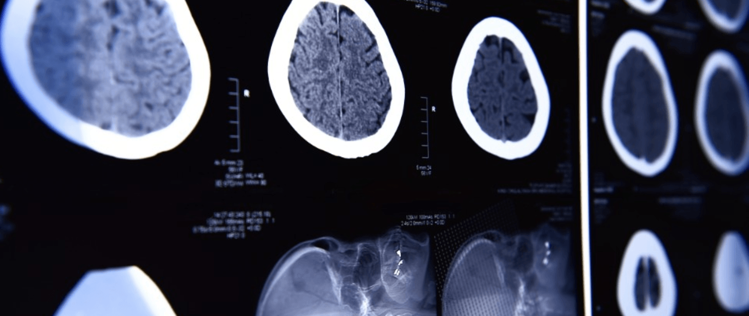 Artificial Intelligence for Dementia Diagnosis - Genetic Analysis, Speech Analysis, and More